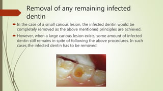 Removal of any remaining infected
dentin
 In the case of a small carious lesion, the infected dentin would be
completely removed as the above mentioned principles are achieved.
 However, when a large carious lesion exists, some amount of infected
dentin still remains in spite of following the above procedures. In such
cases the infected dentin has to be removed.
 