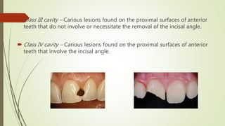  Class III cavity – Carious lesions found on the proximal surfaces of anterior
teeth that do not involve or necessitate the removal of the incisal angle.
 Class IV cavity – Carious lesions found on the proximal surfaces of anterior
teeth that involve the incisal angle.
 