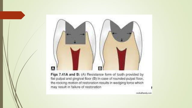 Class II cavity preparation | PPTX | Dental Health | Diseases and ...