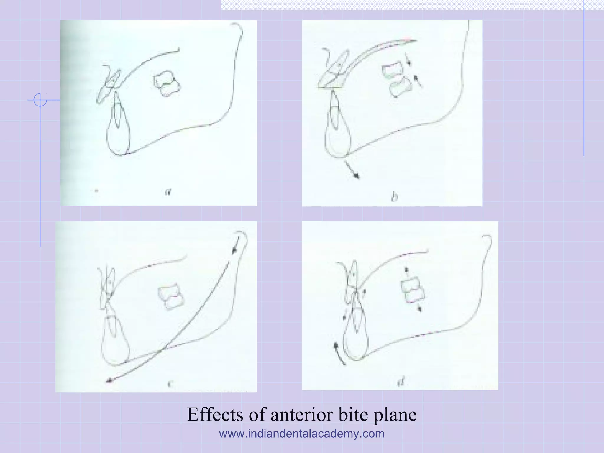 Effects of anterior bite plane
www.indiandentalacademy.com
 