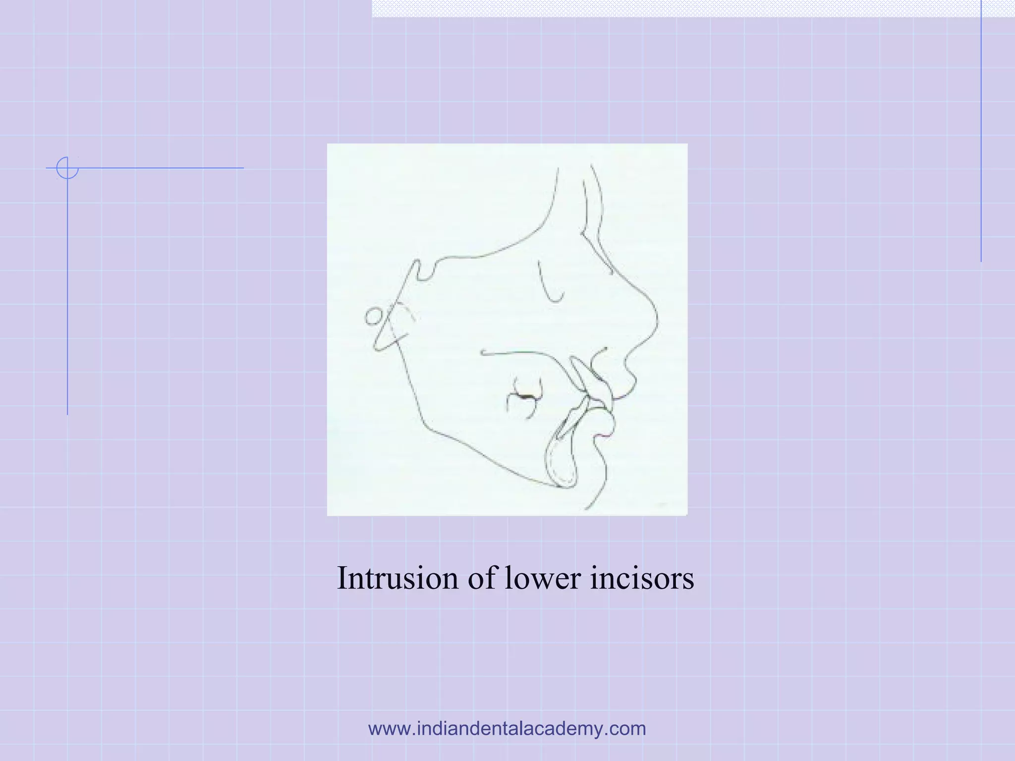 Intrusion of lower incisors
www.indiandentalacademy.com
 