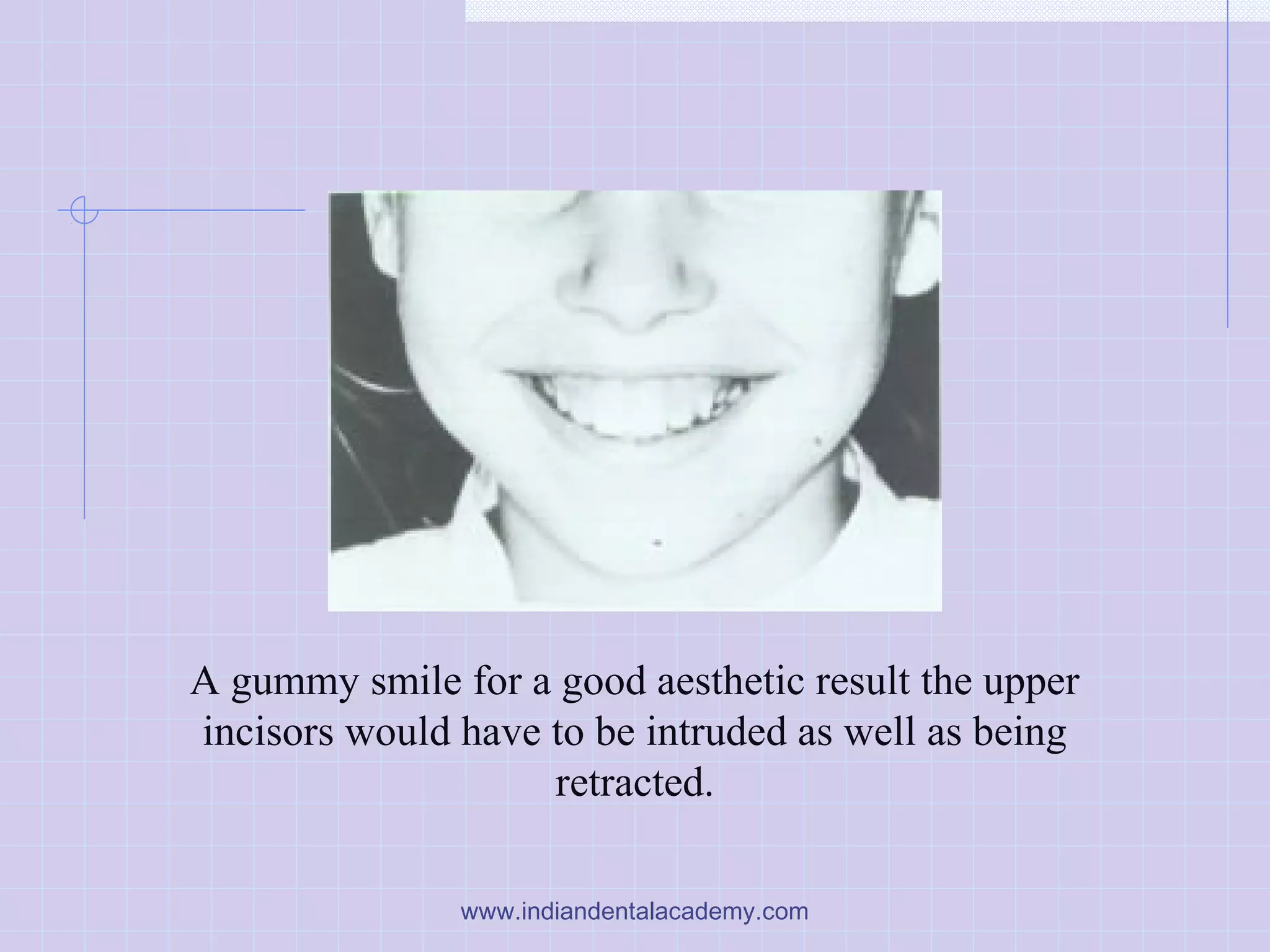 A gummy smile for a good aesthetic result the upper
incisors would have to be intruded as well as being
retracted.
www.indiandentalacademy.com
 