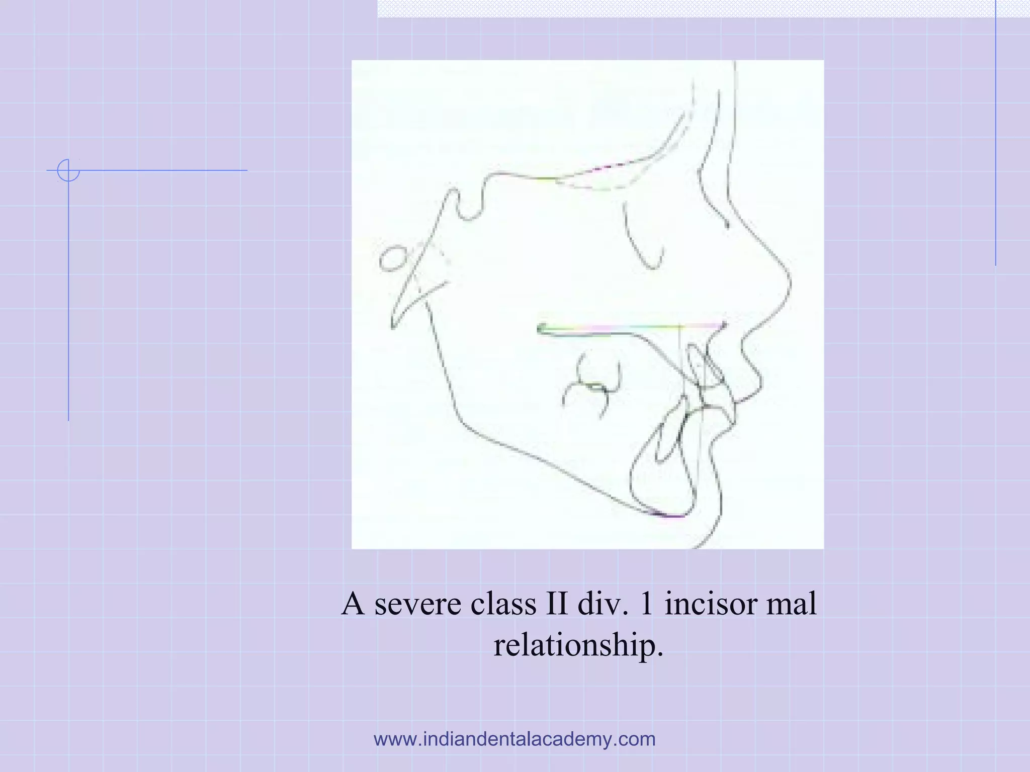 A severe class II div. 1 incisor mal
relationship.
www.indiandentalacademy.com
 