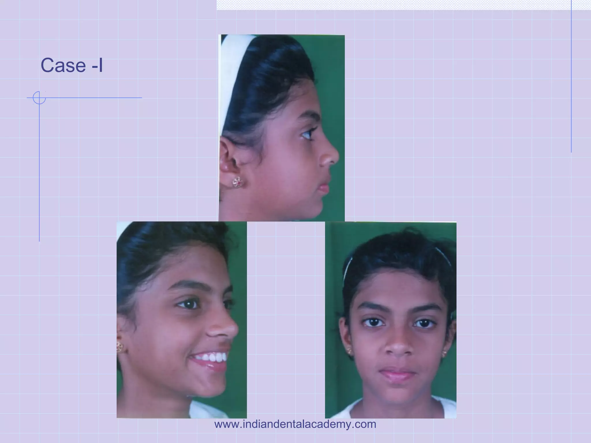 Case -I
www.indiandentalacademy.com
 