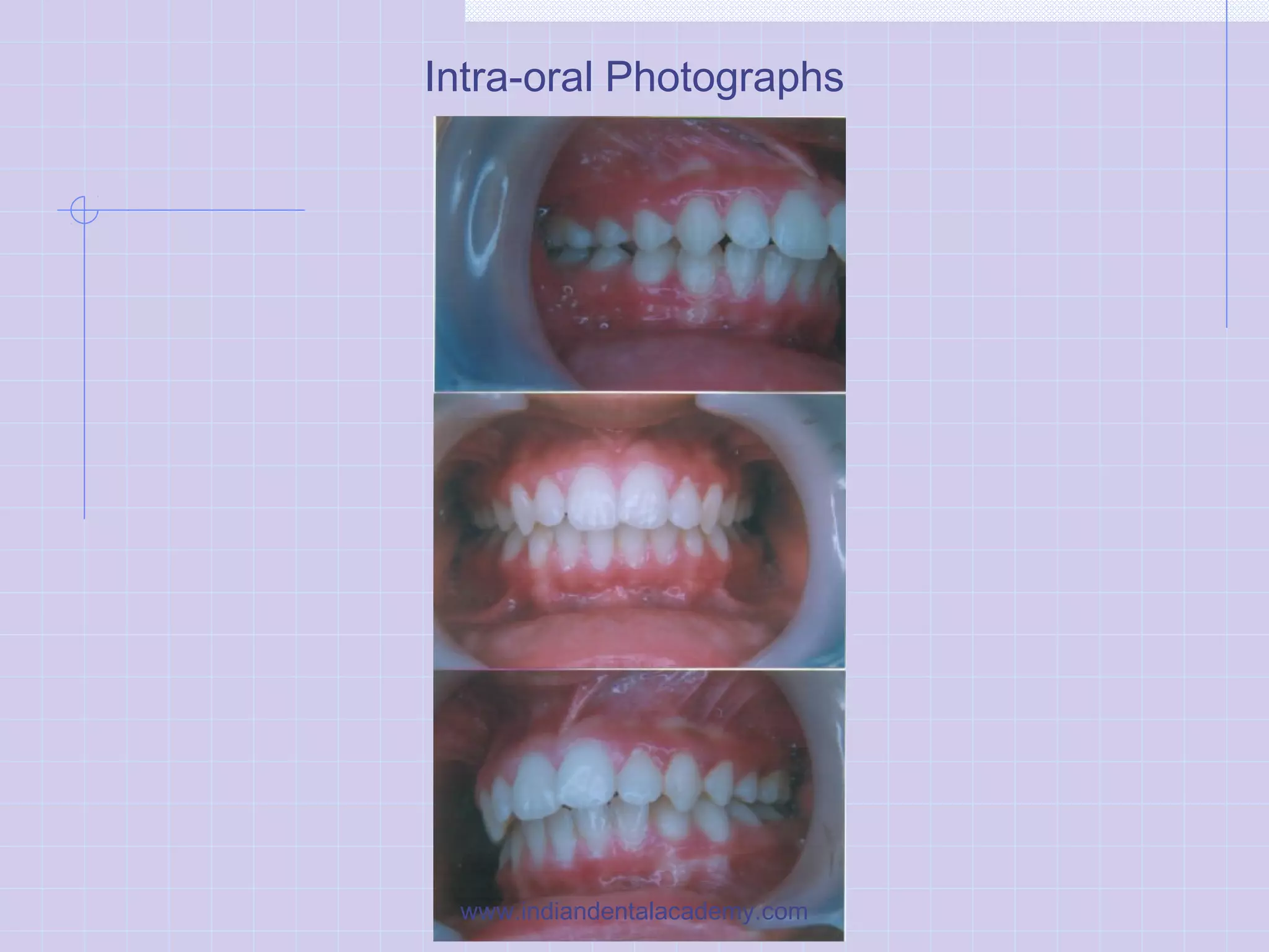 Intra-oral Photographs
www.indiandentalacademy.com
 