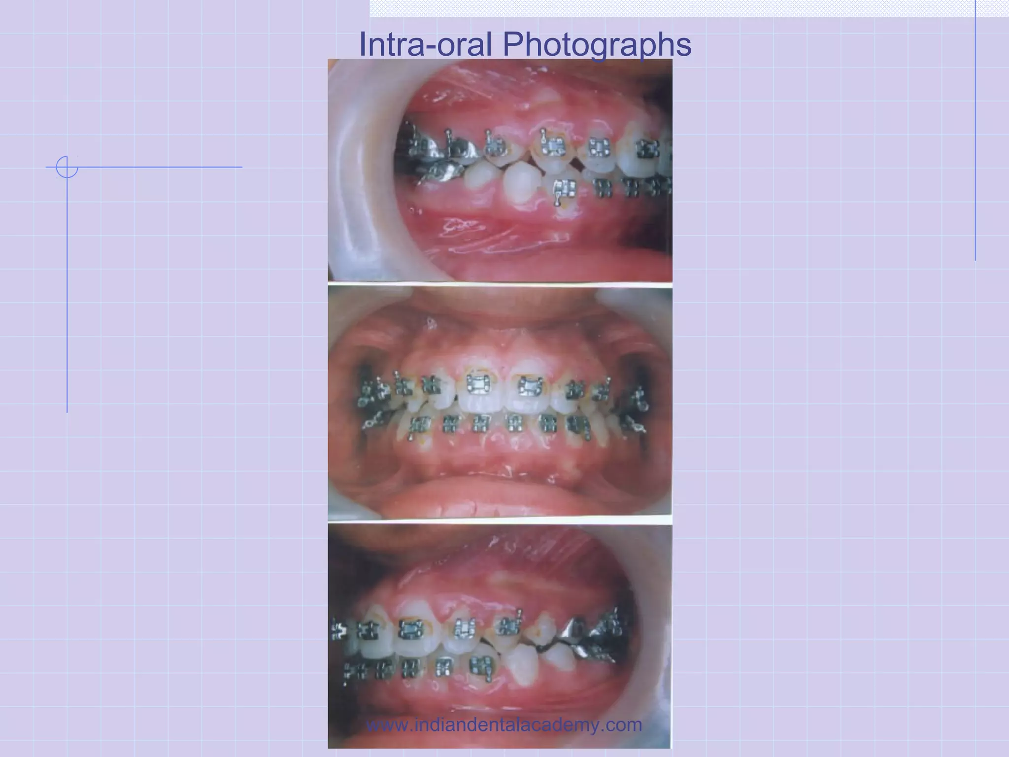 Intra-oral Photographs
www.indiandentalacademy.com
 