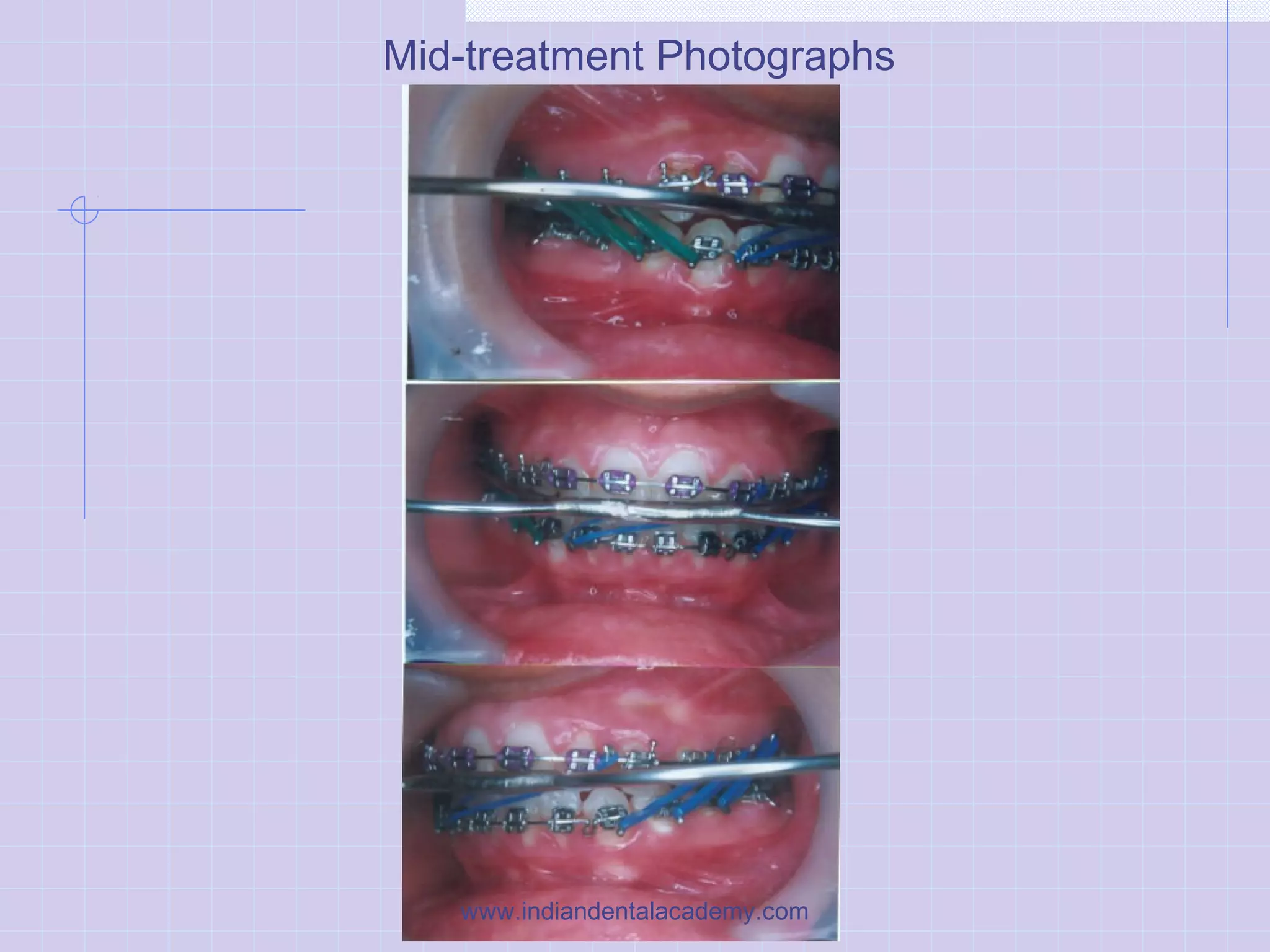 Mid-treatment Photographs
www.indiandentalacademy.com
 