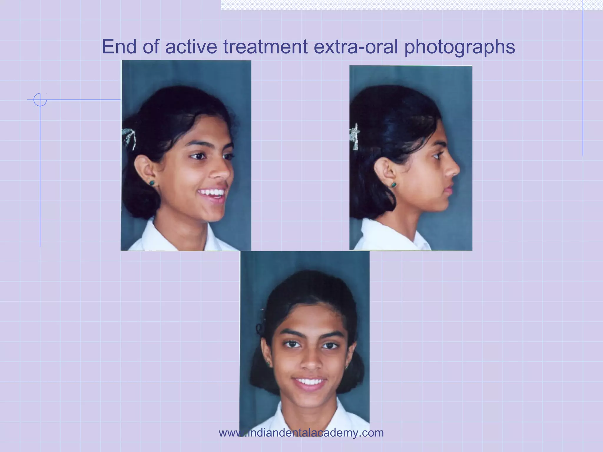 End of active treatment extra-oral photographs
www.indiandentalacademy.com
 