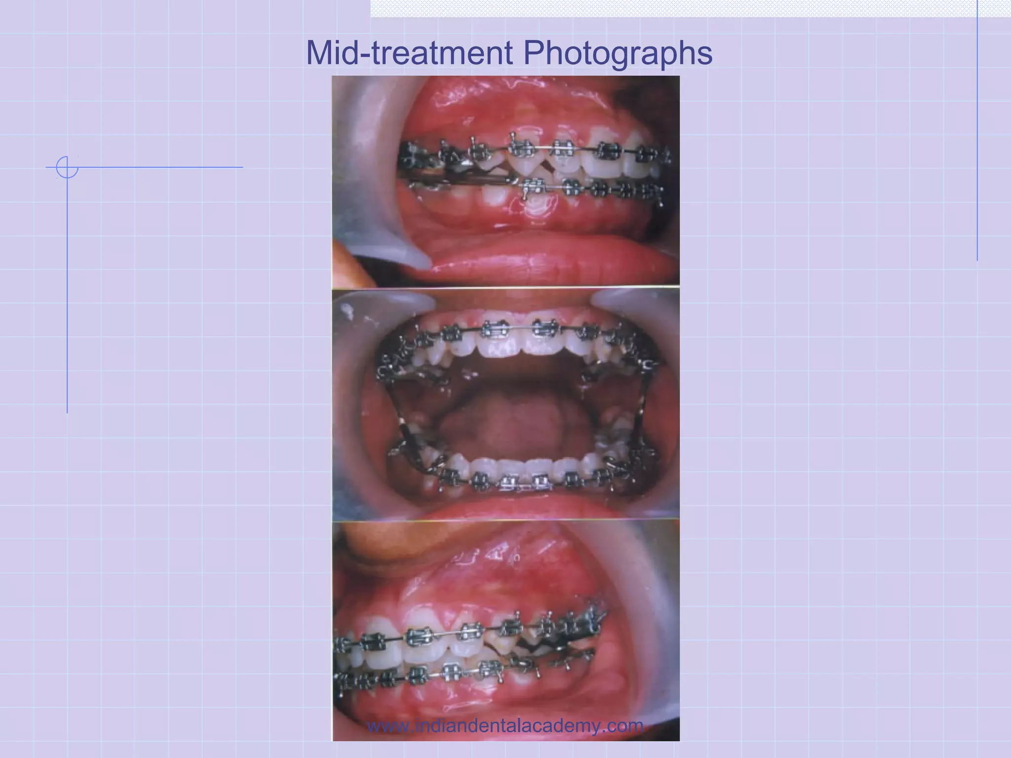 Mid-treatment Photographs
www.indiandentalacademy.com
 