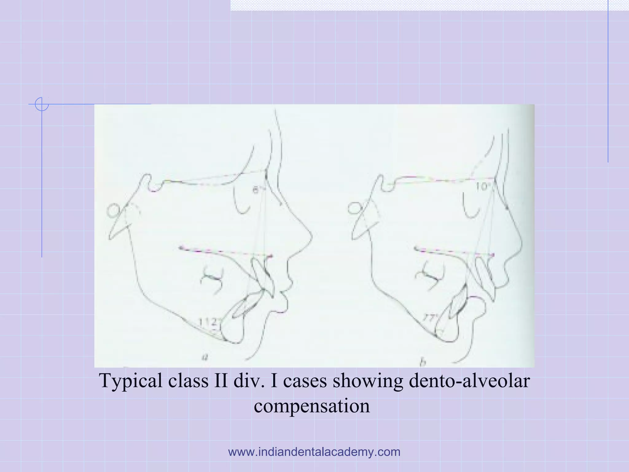 Typical class II div. I cases showing dento-alveolar
compensation
www.indiandentalacademy.com
 