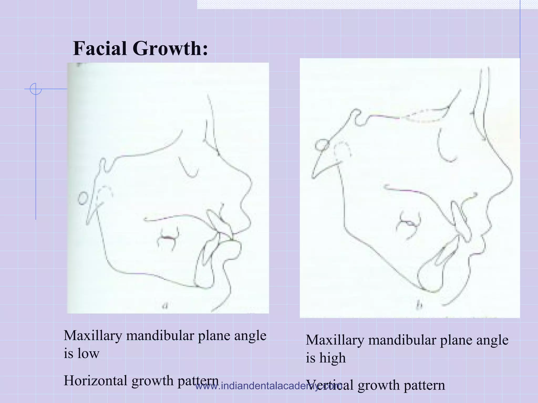Facial Growth:
Maxillary mandibular plane angle
is low
Horizontal growth pattern
Maxillary mandibular plane angle
is high
Vertical growth patternwww.indiandentalacademy.com
 
