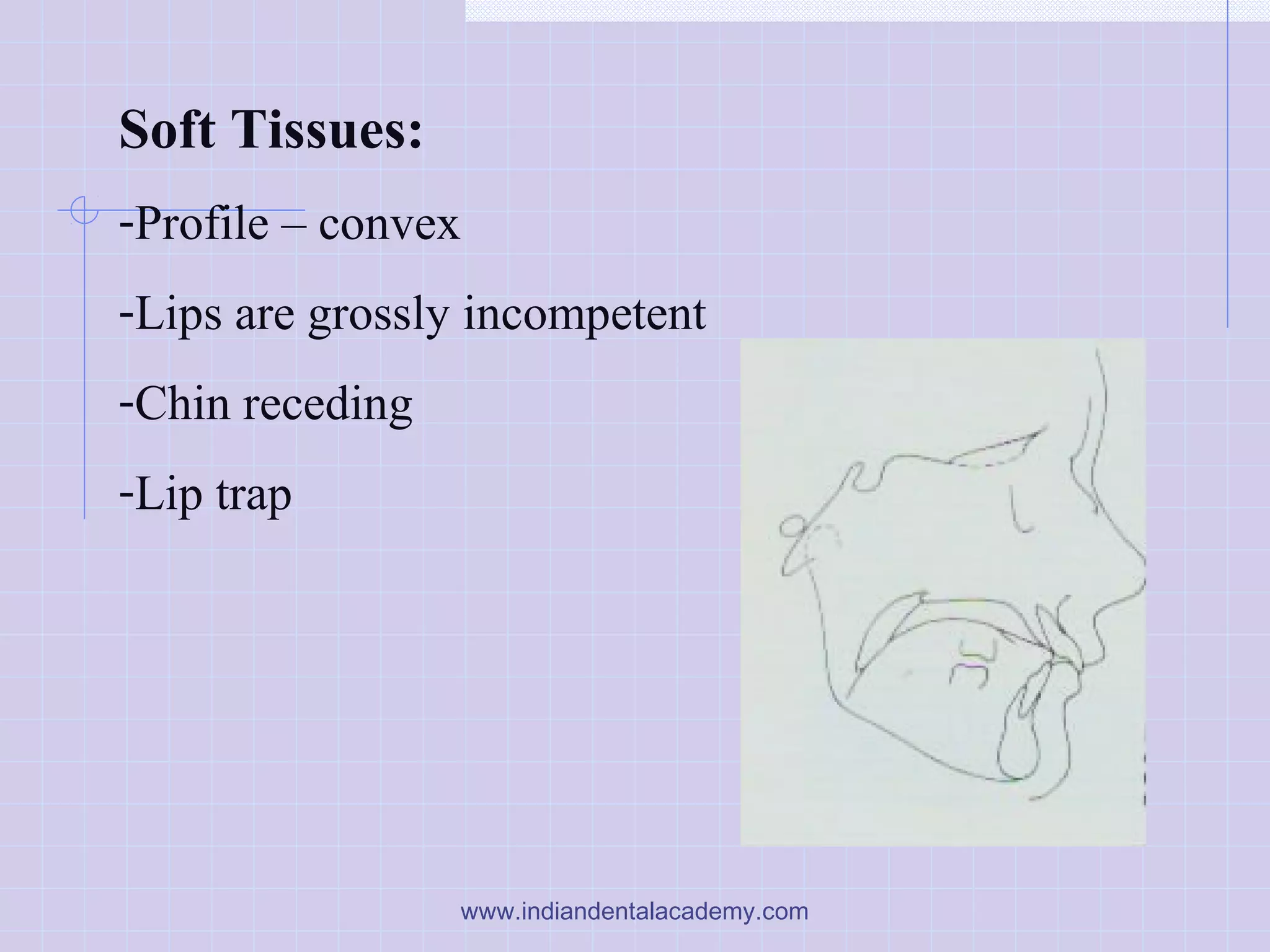Soft Tissues:
-Profile – convex
-Lips are grossly incompetent
-Chin receding
-Lip trap
www.indiandentalacademy.com
 