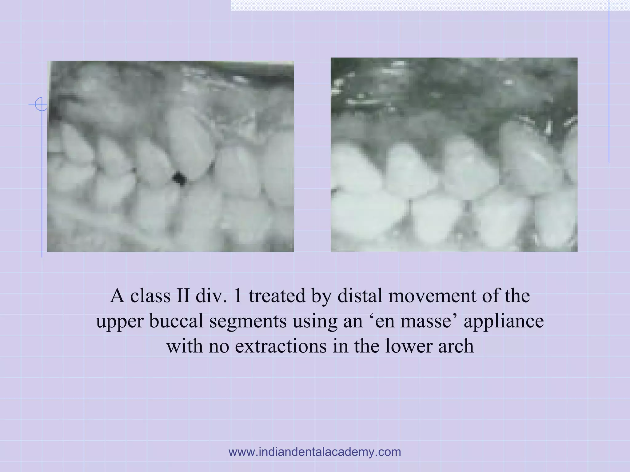 A class II div. 1 treated by distal movement of the
upper buccal segments using an ‘en masse’ appliance
with no extractions in the lower arch
www.indiandentalacademy.com
 
