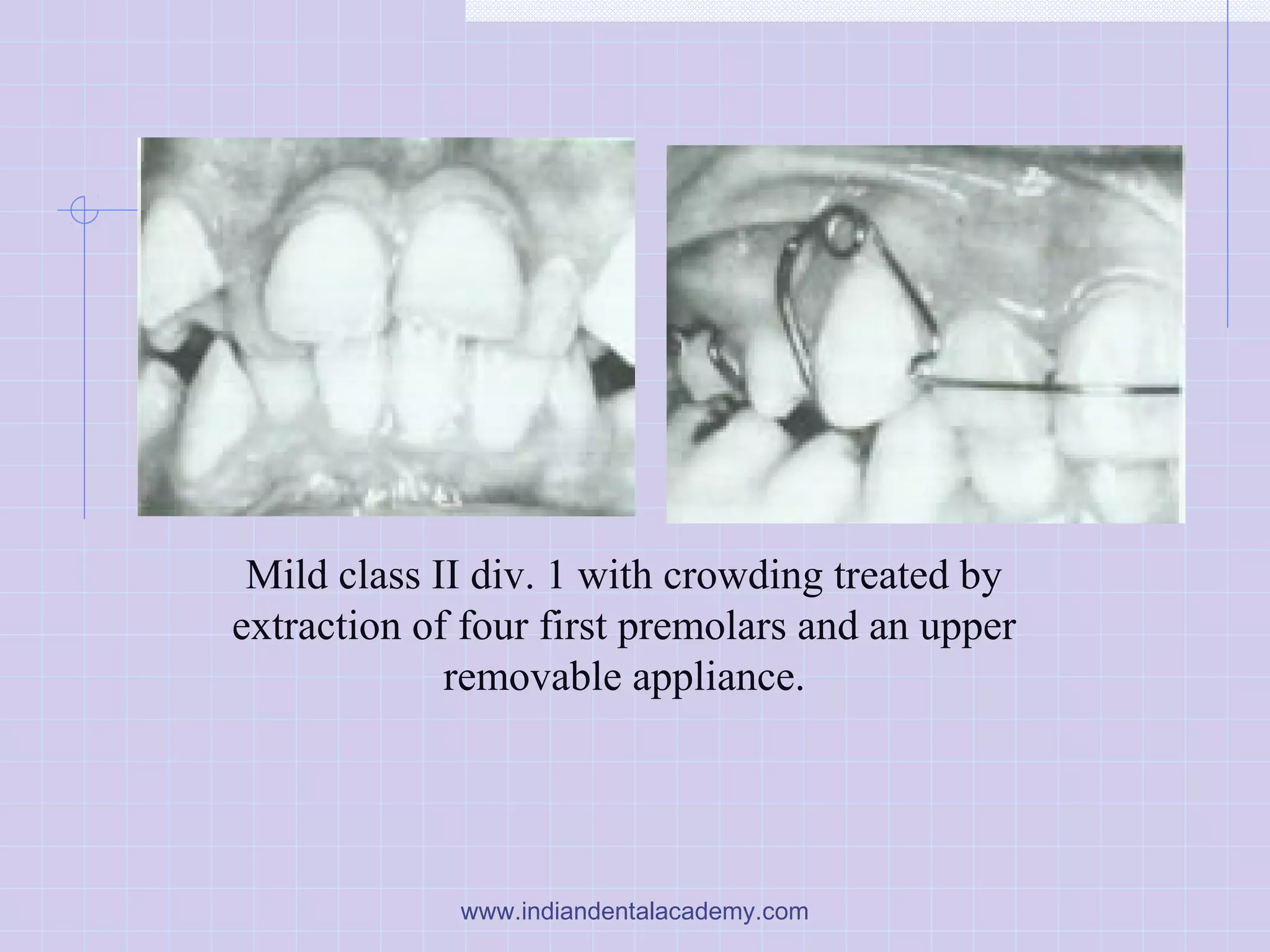 Mild class II div. 1 with crowding treated by
extraction of four first premolars and an upper
removable appliance.
www.indiandentalacademy.com
 