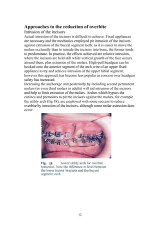 Approaches to the reduction of overbite
Intrusion of the incisors
Actual intrusion of the incisors is difficult to achieve. Fixed appliances
are necessary and the mechanics employed pit intrusion of the incisors
against extrusion of the buccal segment teeth; as it is easier to move the
molars occlusally than to intrude the incisors into bone, the former tends
to predominate. In practice, the effects achieved are relative intrusion,
where the incisors are held still while vertical growth of the face occurs
around them, plus extrusion of the molars. High-pull headgear can be
hooked onto the anterior segment of the arch-wire of an upper fixed
appliance to try and achieve intrusion of the upper labial segment;
however this approach has become less popular as concern over headgear
safety has increased.
Increasing the anchorage unit posteriorly by including second permanent
molars (or even third molars in adults) will aid intrusion of the incisors
and help to limit extrusion of the molars. Arches which bypass the
canines and premolars to pit the incisors against the molars, for example
the utility arch (fig 18), are employed with some success to reduce
overbite by intrusion of the incisors, although some molar extrusion does
occur.




                                    12
 