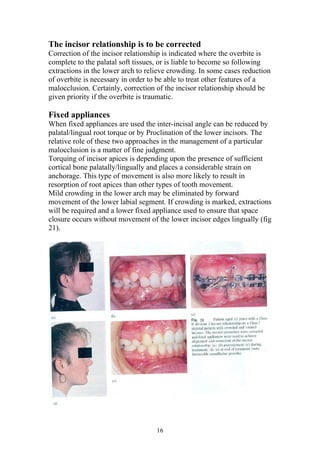 The incisor relationship is to be corrected
Correction of the incisor relationship is indicated where the overbite is
complete to the palatal soft tissues, or is liable to become so following
extractions in the lower arch to relieve crowding. In some cases reduction
of overbite is necessary in order to be able to treat other features of a
malocclusion. Certainly, correction of the incisor relationship should be
given priority if the overbite is traumatic.

Fixed appliances
When fixed appliances are used the inter-incisal angle can be reduced by
palatal/lingual root torque or by Proclination of the lower incisors. The
relative role of these two approaches in the management of a particular
malocclusion is a matter of fine judgment.
Torquing of incisor apices is depending upon the presence of sufficient
cortical bone palatally/lingually and places a considerable strain on
anchorage. This type of movement is also more likely to result in
resorption of root apices than other types of tooth movement.
Mild crowding in the lower arch may be eliminated by forward
movement of the lower labial segment. If crowding is marked, extractions
will be required and a lower fixed appliance used to ensure that space
closure occurs without movement of the lower incisor edges lingually (fig
21).




                                    16
 