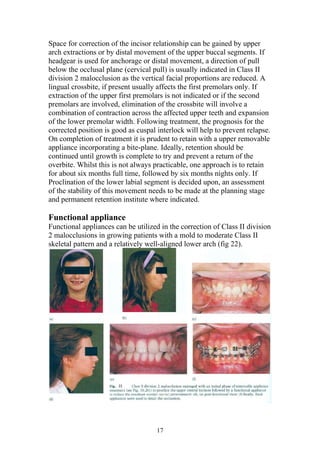Space for correction of the incisor relationship can be gained by upper
arch extractions or by distal movement of the upper buccal segments. If
headgear is used for anchorage or distal movement, a direction of pull
below the occlusal plane (cervical pull) is usually indicated in Class II
division 2 malocclusion as the vertical facial proportions are reduced. A
lingual crossbite, if present usually affects the first premolars only. If
extraction of the upper first premolars is not indicated or if the second
premolars are involved, elimination of the crossbite will involve a
combination of contraction across the affected upper teeth and expansion
of the lower premolar width. Following treatment, the prognosis for the
corrected position is good as cuspal interlock will help to prevent relapse.
On completion of treatment it is prudent to retain with a upper removable
appliance incorporating a bite-plane. Ideally, retention should be
continued until growth is complete to try and prevent a return of the
overbite. Whilst this is not always practicable, one approach is to retain
for about six months full time, followed by six months nights only. If
Proclination of the lower labial segment is decided upon, an assessment
of the stability of this movement needs to be made at the planning stage
and permanent retention institute where indicated.

Functional appliance
Functional appliances can be utilized in the correction of Class II division
2 malocclusions in growing patients with a mold to moderate Class II
skeletal pattern and a relatively well-aligned lower arch (fig 22).




                                     17
 