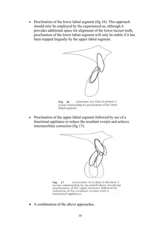 •   Proclination of the lower labial segment (fig 16). This approach
    should only be employed by the experienced as, although it
    provides additional space for alignment of the lower incisor teeth,
    proclination of the lower labial segment will only be stable if it has
    been trapped lingually by the upper labial segment.




•   Proclination of the upper labial segment followed by use of a
    functional appliance to reduce the resultant overjet and achieve
    intermaxillary correction (fig 17).




• A combination of the above approaches.

                                  10
 