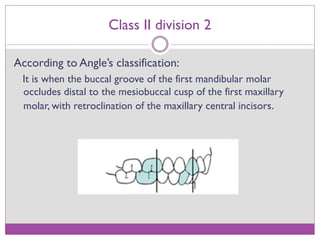 Class II division 2 malocclusion | PPTX