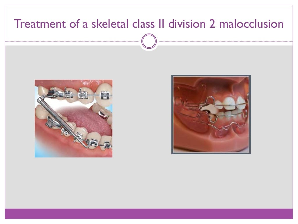 Class II division 2 malocclusion