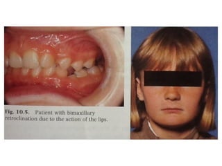 Classification 2 Lessive Class II division 2 malocclusion of dentistry.pptx