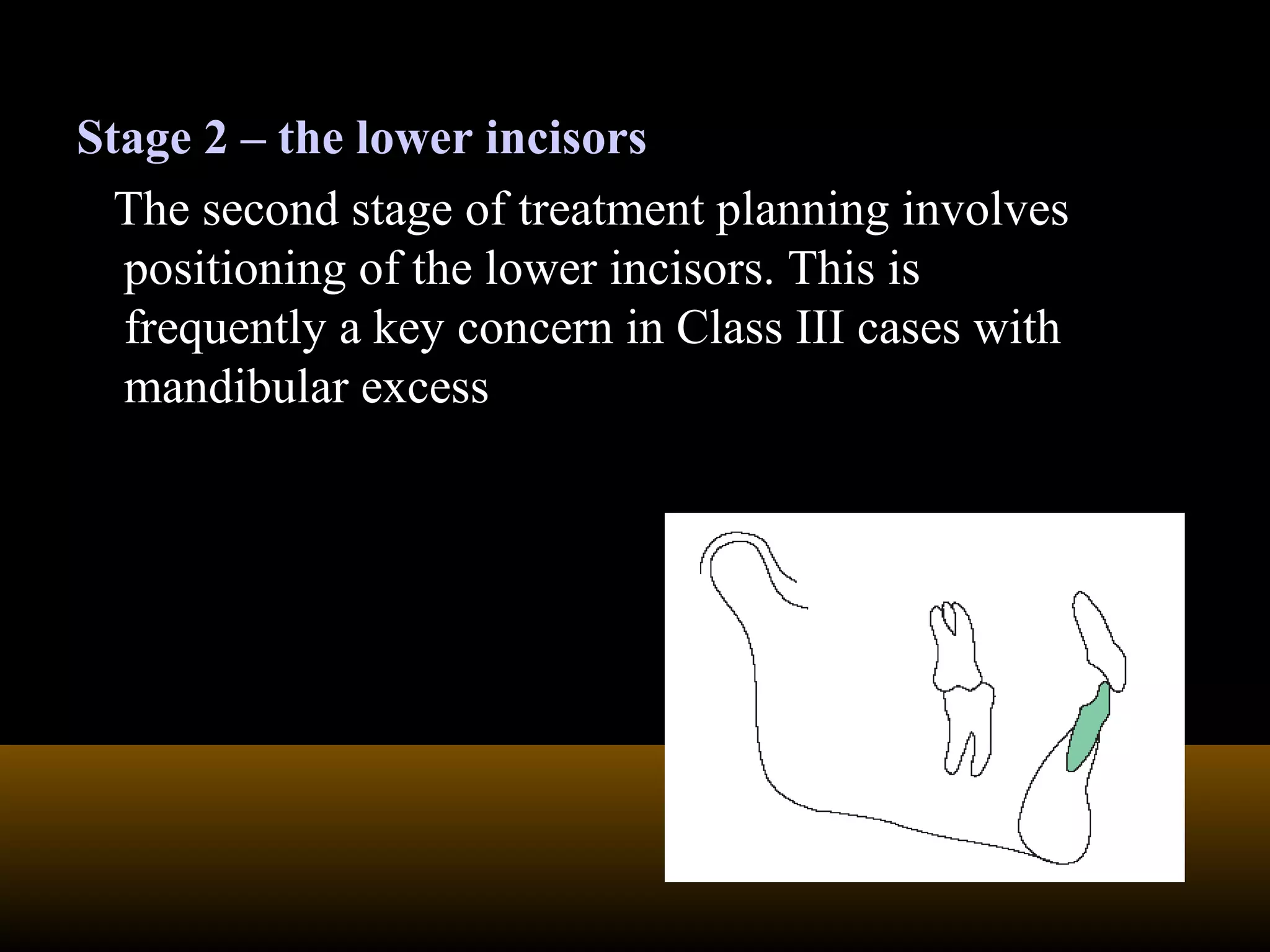 Stage 2 – the lower incisors
The second stage of treatment planning involves
positioning of the lower incisors. This is
frequently a key concern in Class III cases with
mandibular excess
 