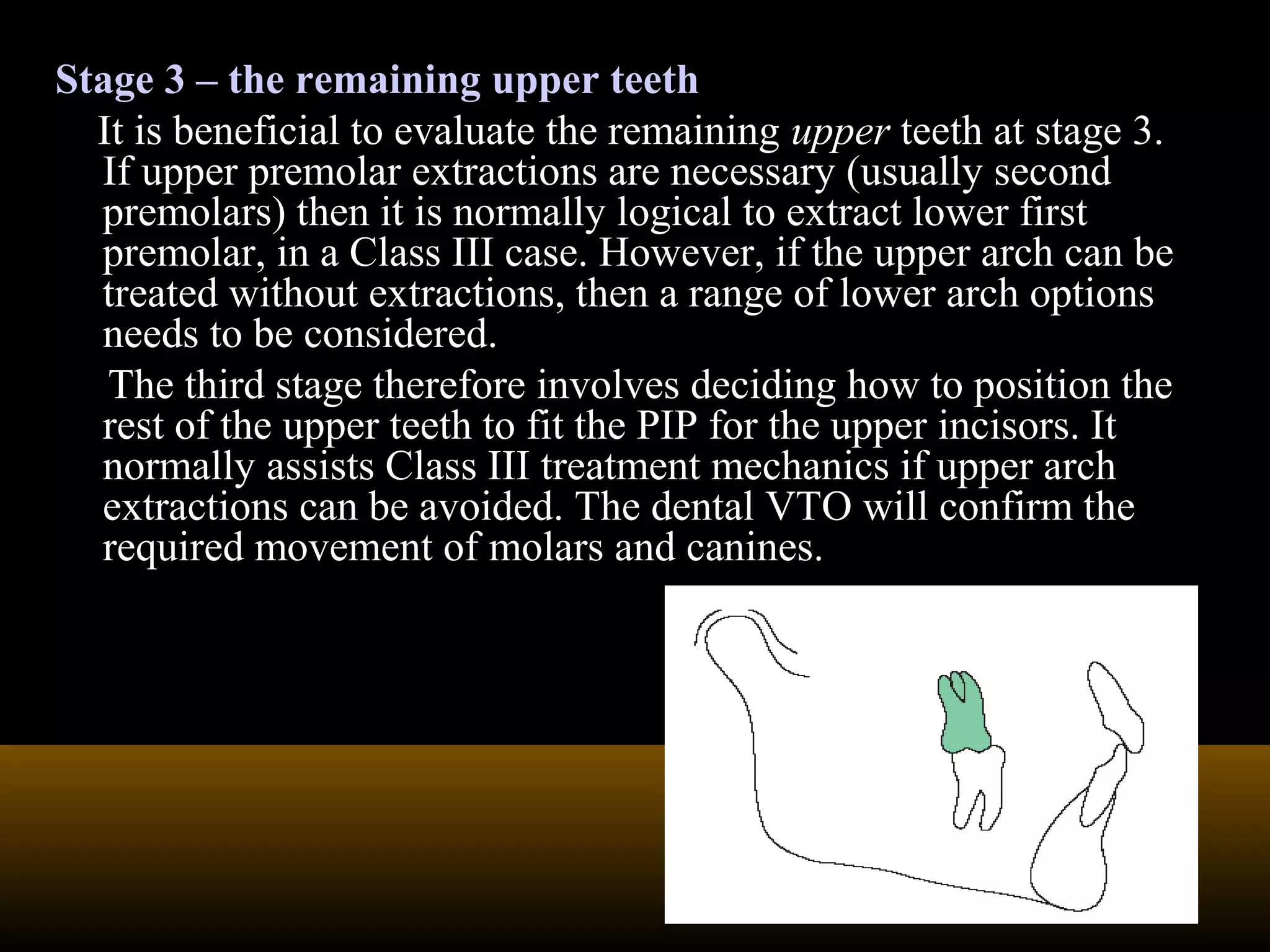 Stage 3 – the remaining upper teeth
It is beneficial to evaluate the remaining upper teeth at stage 3.
If upper premolar extractions are necessary (usually second
premolars) then it is normally logical to extract lower first
premolar, in a Class III case. However, if the upper arch can be
treated without extractions, then a range of lower arch options
needs to be considered.
The third stage therefore involves deciding how to position the
rest of the upper teeth to fit the PIP for the upper incisors. It
normally assists Class III treatment mechanics if upper arch
extractions can be avoided. The dental VTO will confirm the
required movement of molars and canines.
 