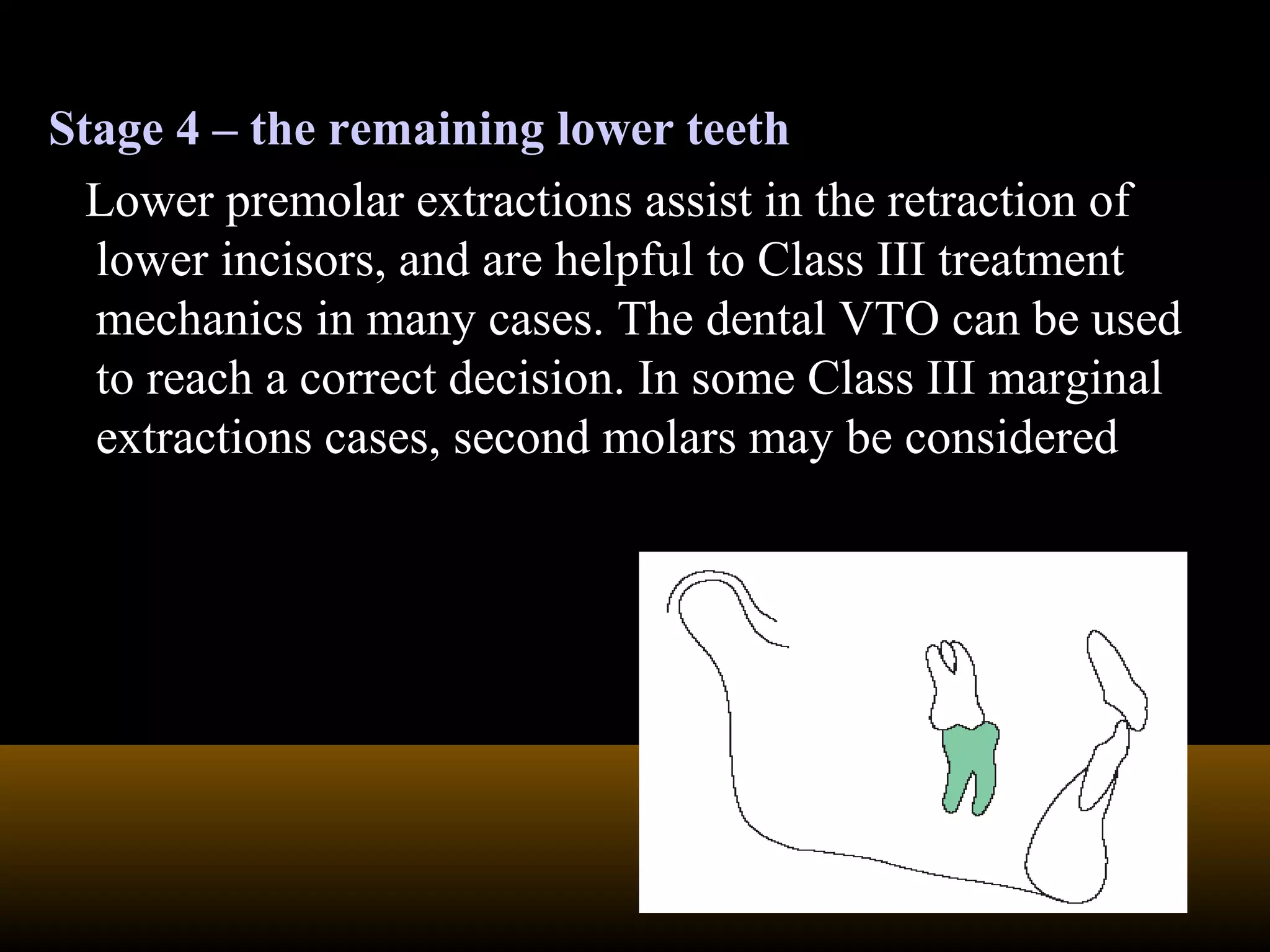 Stage 4 – the remaining lower teeth
Lower premolar extractions assist in the retraction of
lower incisors, and are helpful to Class III treatment
mechanics in many cases. The dental VTO can be used
to reach a correct decision. In some Class III marginal
extractions cases, second molars may be considered
 