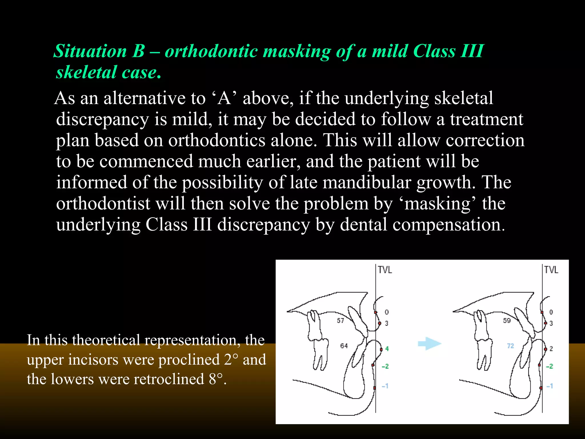 Situation B – orthodontic masking of a mild Class III
skeletal case.
As an alternative to ‘A’ above, if the underlying skeletal
discrepancy is mild, it may be decided to follow a treatment
plan based on orthodontics alone. This will allow correction
to be commenced much earlier, and the patient will be
informed of the possibility of late mandibular growth. The
orthodontist will then solve the problem by ‘masking’ the
underlying Class III discrepancy by dental compensation.
In this theoretical representation, the
upper incisors were proclined 2° and
the lowers were retroclined 8°.
 