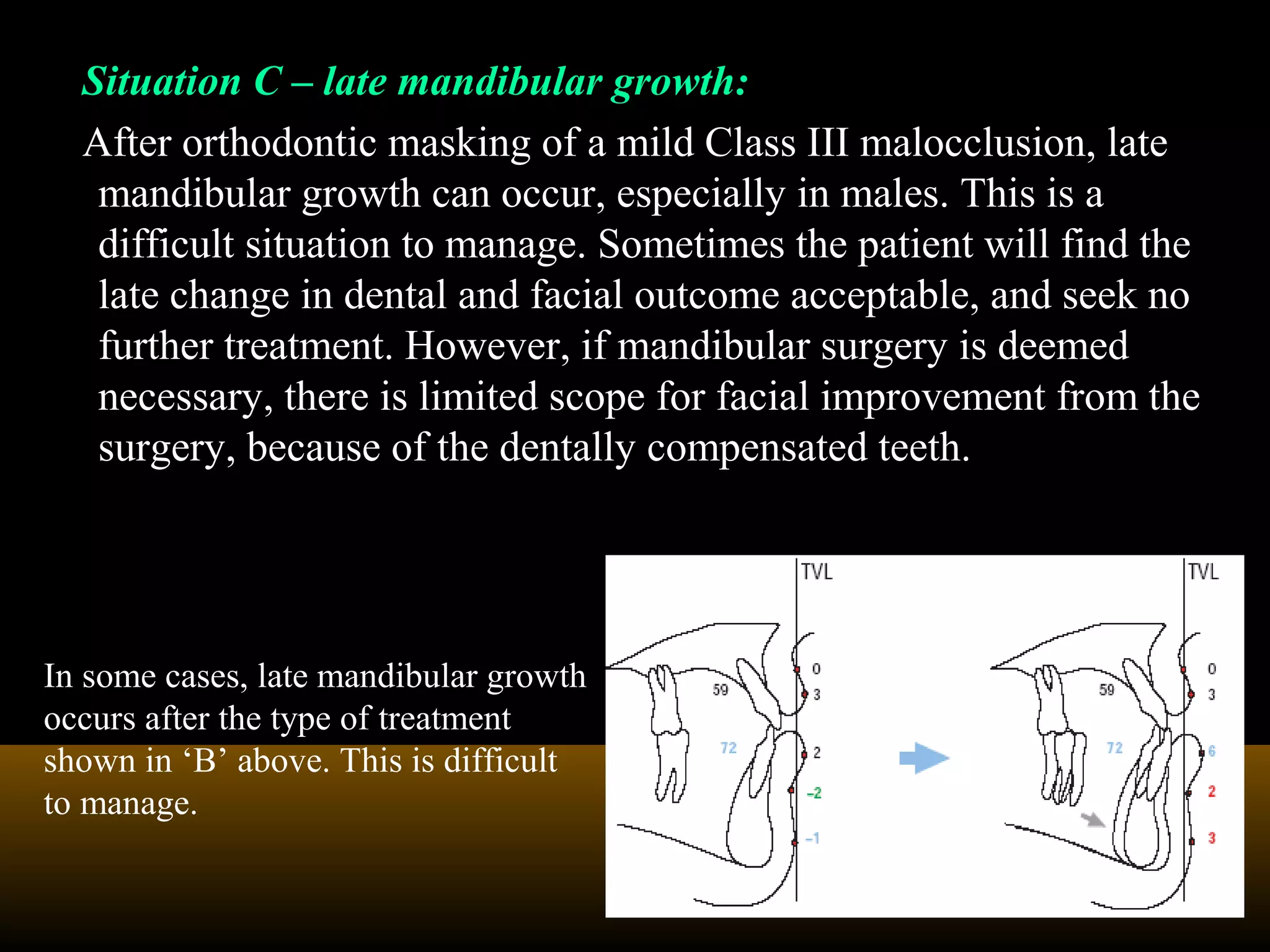 Situation C – late mandibular growth:
After orthodontic masking of a mild Class III malocclusion, late
mandibular growth can occur, especially in males. This is a
difficult situation to manage. Sometimes the patient will find the
late change in dental and facial outcome acceptable, and seek no
further treatment. However, if mandibular surgery is deemed
necessary, there is limited scope for facial improvement from the
surgery, because of the dentally compensated teeth.
In some cases, late mandibular growth
occurs after the type of treatment
shown in ‘B’ above. This is difficult
to manage.
 