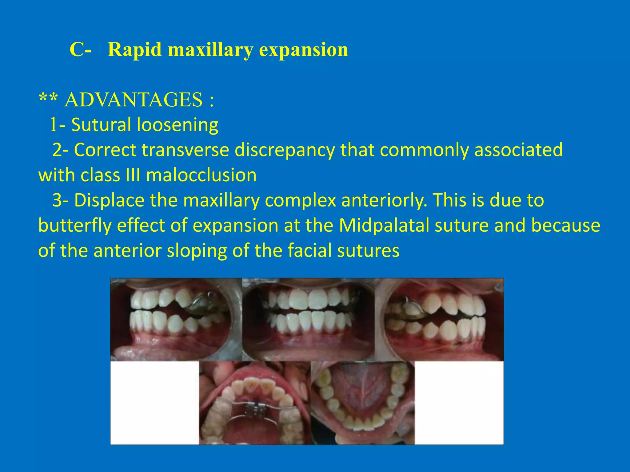 C- Rapid maxillary expansion
** ADVANTAGES :
1- Sutural loosening
2- Correct transverse discrepancy that commonly associated
with class III malocclusion
3- Displace the maxillary complex anteriorly. This is due to
butterfly effect of expansion at the Midpalatal suture and because
of the anterior sloping of the facial sutures
 