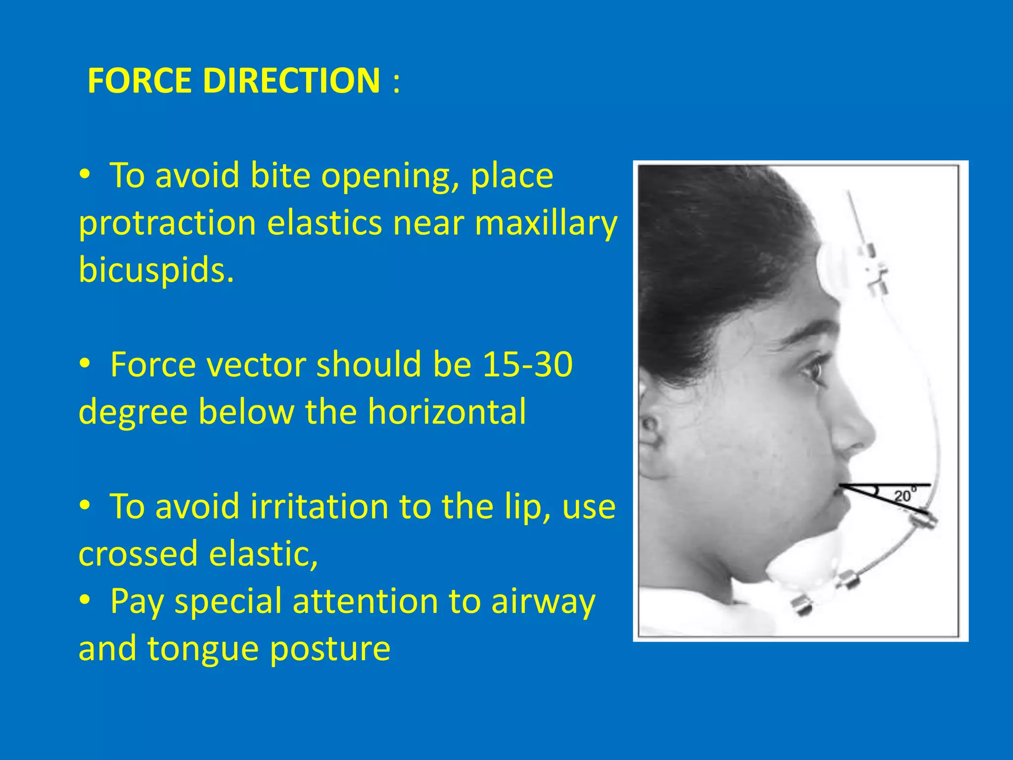 FORCE DIRECTION :
• To avoid bite opening, place
protraction elastics near maxillary
bicuspids.
• Force vector should be 15-30
degree below the horizontal
• To avoid irritation to the lip, use
crossed elastic,
• Pay special attention to airway
and tongue posture
 