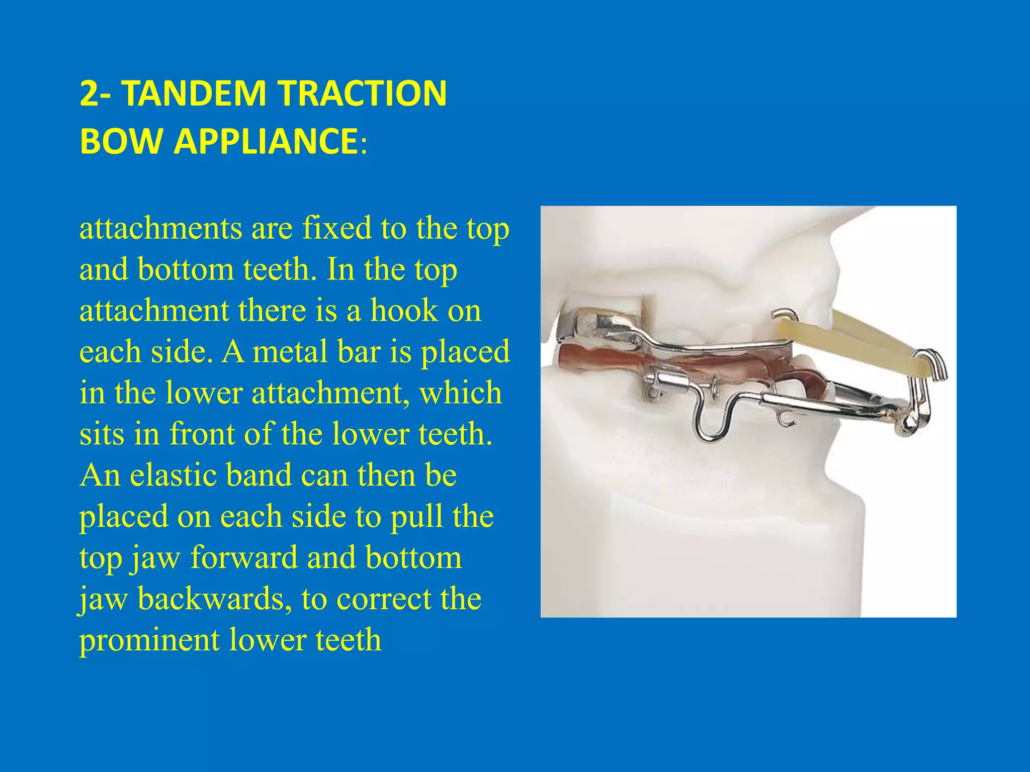 2- TANDEM TRACTION
BOW APPLIANCE:
attachments are fixed to the top
and bottom teeth. In the top
attachment there is a hook on
each side. A metal bar is placed
in the lower attachment, which
sits in front of the lower teeth.
An elastic band can then be
placed on each side to pull the
top jaw forward and bottom
jaw backwards, to correct the
prominent lower teeth
 