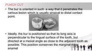 • The bur is oriented in such a way that it penetrates the
carious lesion which is usually gingival to distal contact
point.
• Ideally, the bur is positioned so that its long axis is
perpendicular to the lingual surface of the tooth, but
directed at a mesial angle as close to the adjacent tooth as
possible. This position conserves the marginal ridge
enamel
 