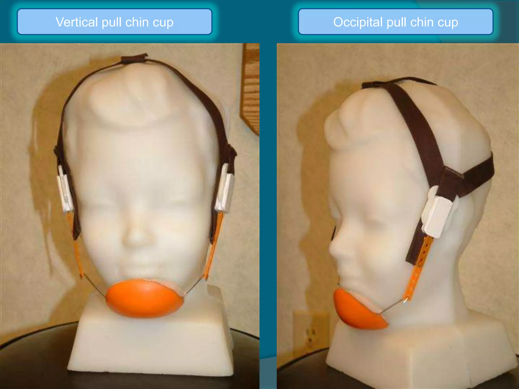 Vertical pull chin cup Occipital pull chin cup
 