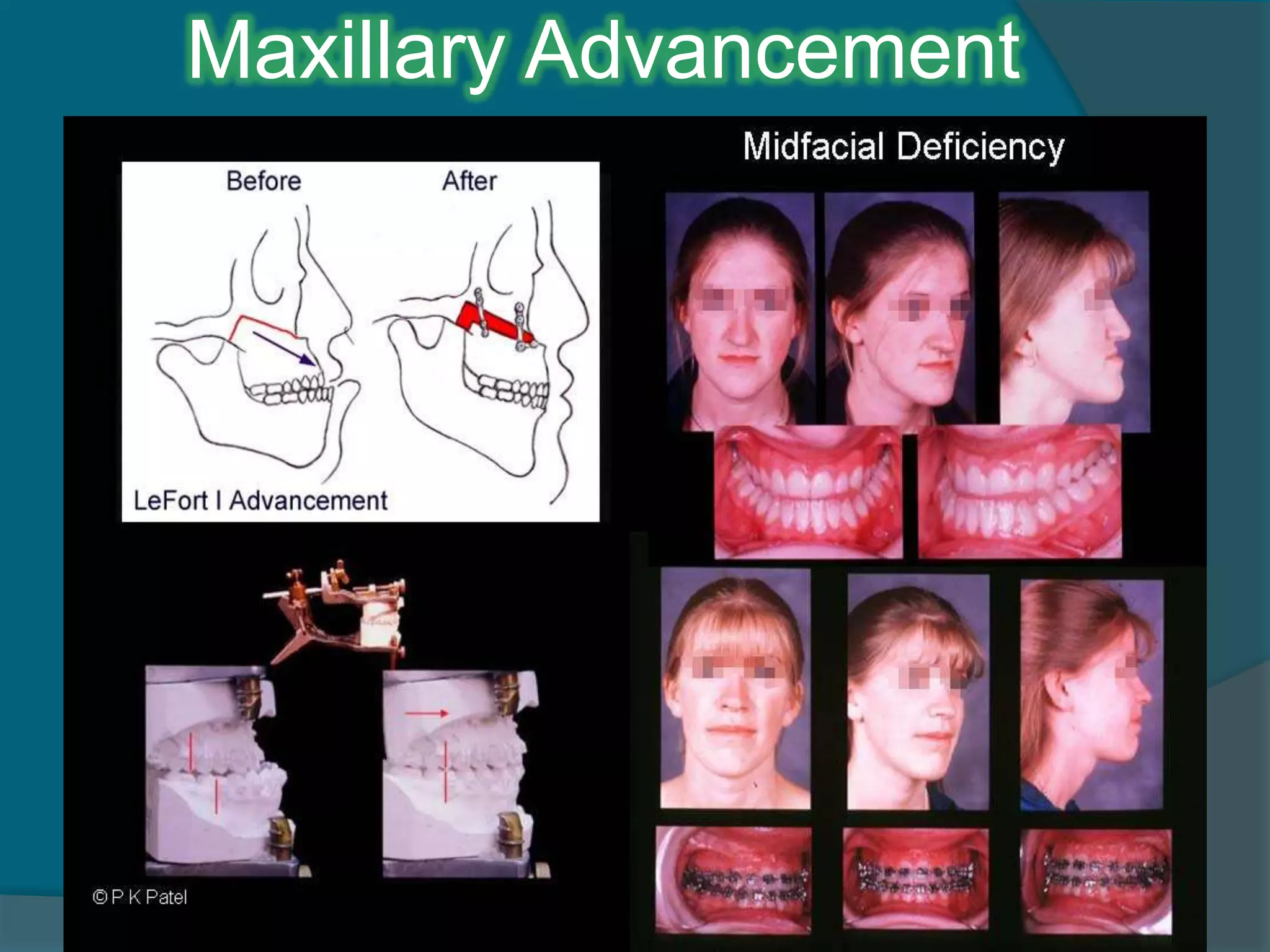 Maxillary Advancement
 