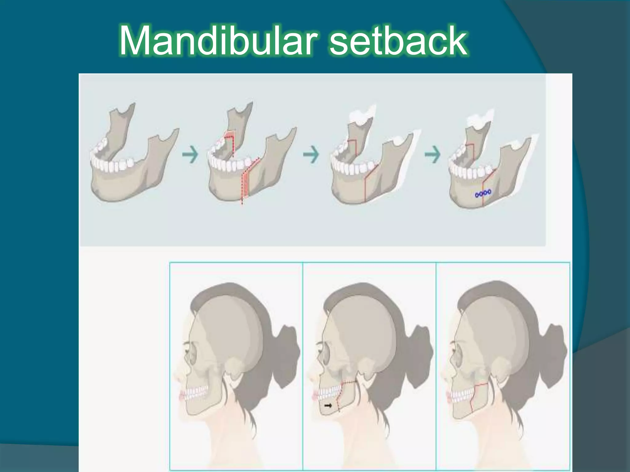 Mandibular setback
 