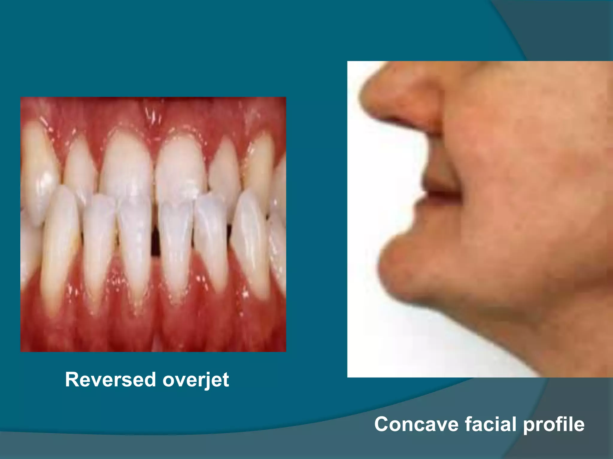 Concave facial profile
Reversed overjet
 