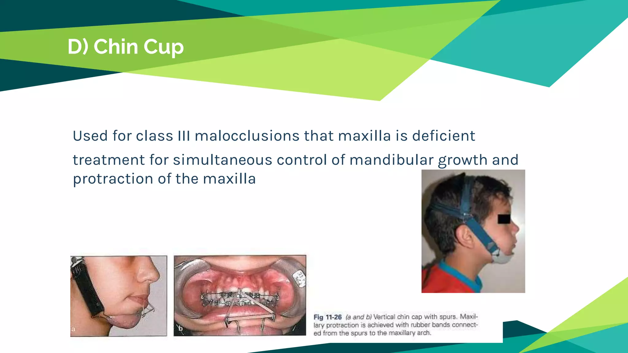 D) Chin Cup
Used for class III malocclusions that maxilla is deficient
treatment for simultaneous control of mandibular growth and
protraction of the maxilla
 