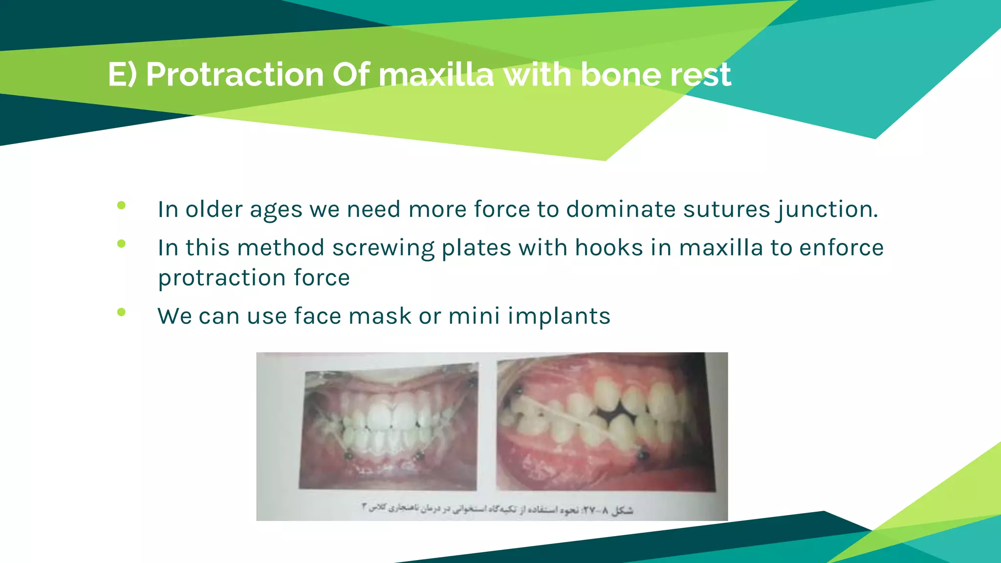 E) Protraction Of maxilla with bone rest
• In older ages we need more force to dominate sutures junction.
• In this method screwing plates with hooks in maxilla to enforce
protraction force
• We can use face mask or mini implants
 
