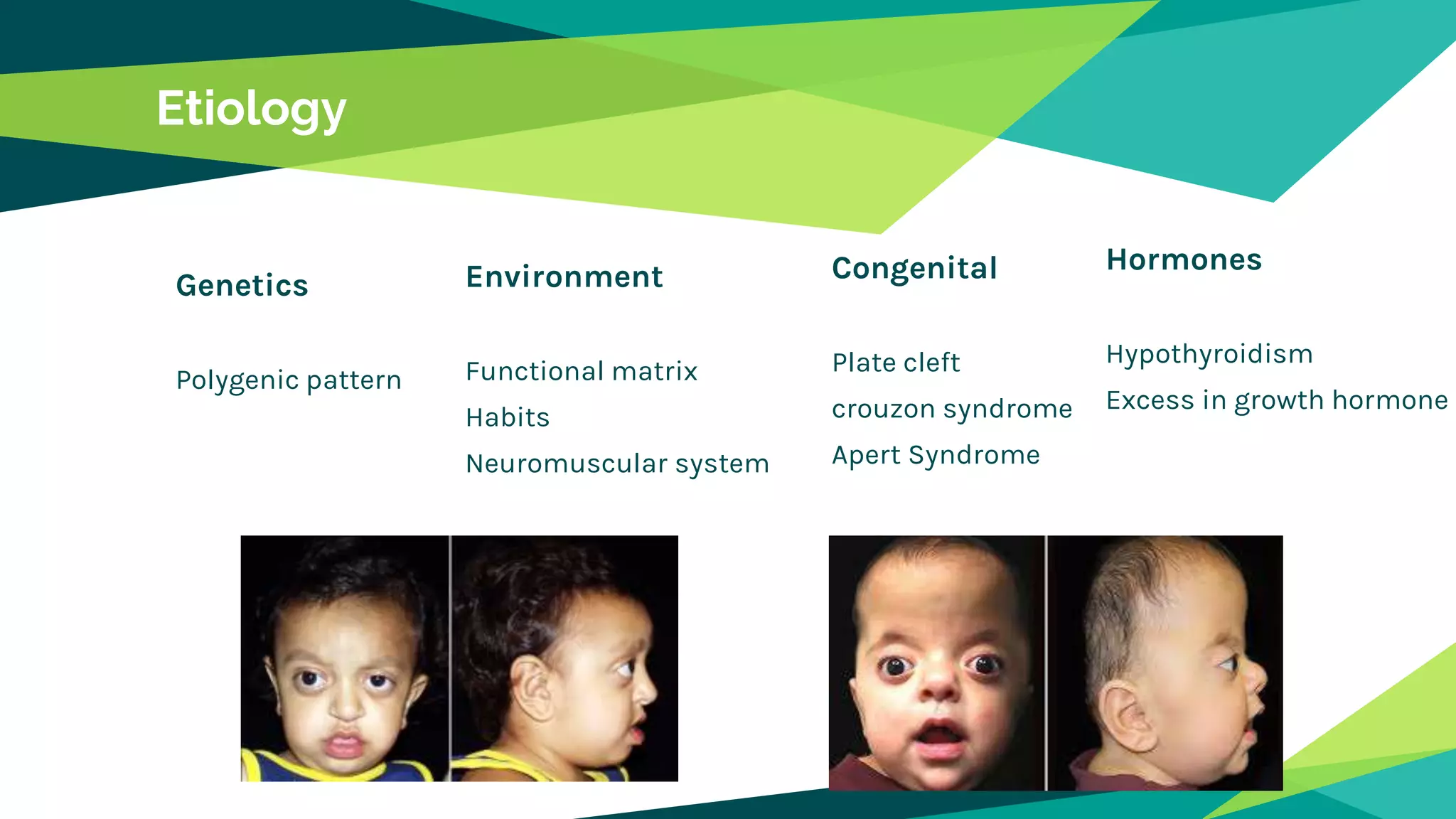Etiology
Genetics
Polygenic pattern
Environment
Functional matrix
Habits
Neuromuscular system
Congenital
Plate cleft
crouzon syndrome
Apert Syndrome
Hormones
Hypothyroidism
Excess in growth hormone
 