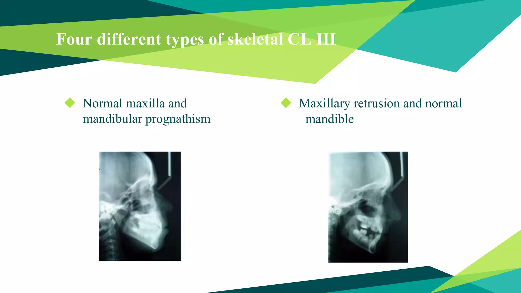 Four different types of skeletal CL III
◆ Normal maxilla and
mandibular prognathism
◆ Maxillary retrusion and normal
mandible
 