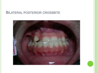 BILATERAL POSTERIOR CROSSBITE
 