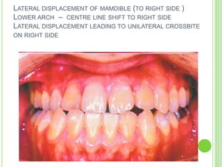 LATERAL DISPLACEMENT OF MAMDIBLE (TO RIGHT SIDE )
LOWER ARCH – CENTRE LINE SHIFT TO RIGHT SIDE
LATERAL DISPLACEMENT LEADING TO UNILATERAL CROSSBITE
ON RIGHT SIDE
 