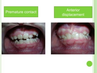 Premature contact Anterior
displacement
 