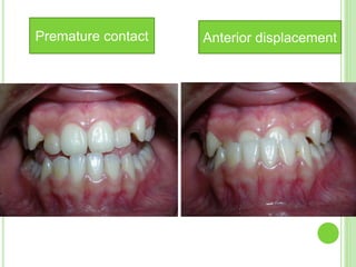 Premature contact Anterior displacement
 