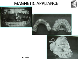VT’s
MAGNETIC APPLIANCE
AO 2005
 