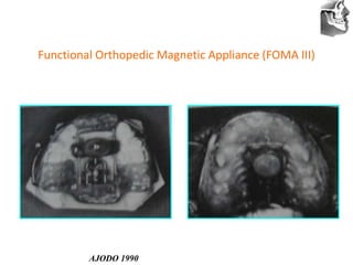 VT’s
Functional Orthopedic Magnetic Appliance (FOMA III)
AJODO 1990
 