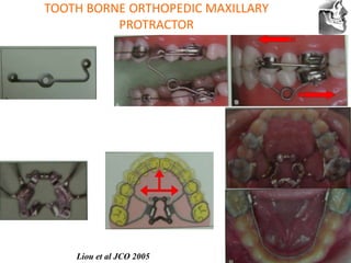 VT’s
TOOTH BORNE ORTHOPEDIC MAXILLARY
PROTRACTOR
Liou et al JCO 2005
 