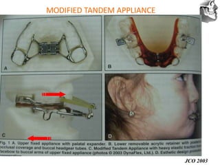 VT’s
MODIFIED TANDEM APPLIANCE
JCO 2003
 